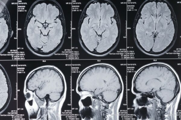 Photo of a cranial MRI